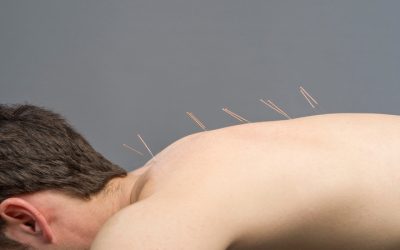 Using Acupuncture In Costa Mesa CA For Healing Orthopedic Injuries