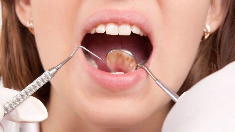 How to Get a Filling Through Dental Services in Beaver Dam, WI