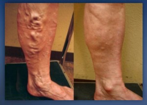 Varicose Veins Removal – 3 Things You Should Know