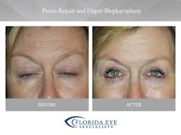 What is Blepharoplasty?