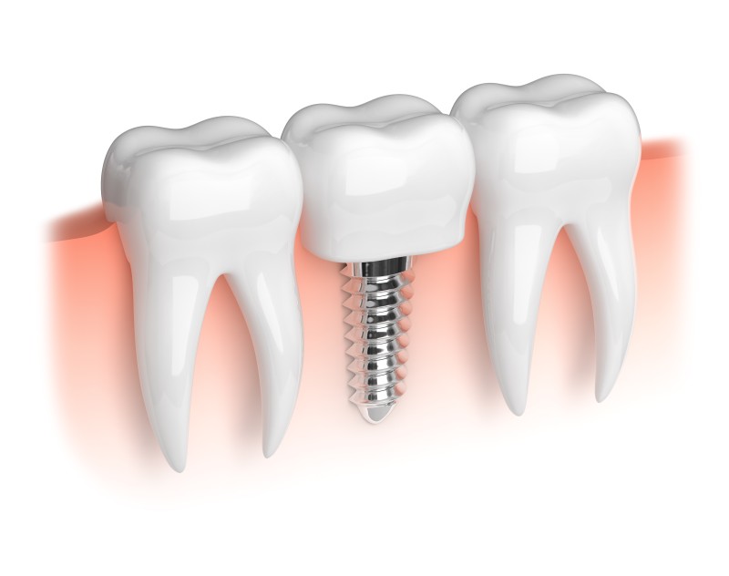 Dental Implants in Salem, OR, Offer a Better Choice Than Traditional Dentures