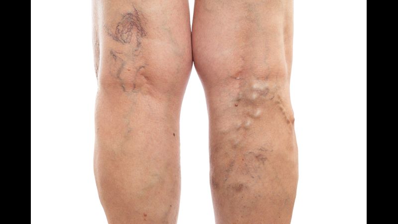 When to See a Vein Specialist in Bensalem, PA